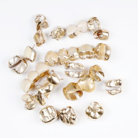 Zahngold: Kronen und Brücken aus Dentallegierung